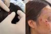 北京女遭發情母貓瘋狂抱頭攻擊毀容全身傷　頭皮被撕開4厘米傷口